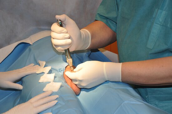 Початок анестезії. Анестетик потрапляє під поверхню шкіри під певним тиском, який нагадує клацання гумки. Після фінального клацання через одну секунду ми можемо продовжувати лікування. 